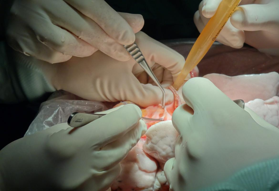 Técnica de Trasplante de Corazón Infantil: Avances en Salud