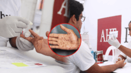 Sífilis en Perú: Alarma sanitaria con 46 mil casos en 2025